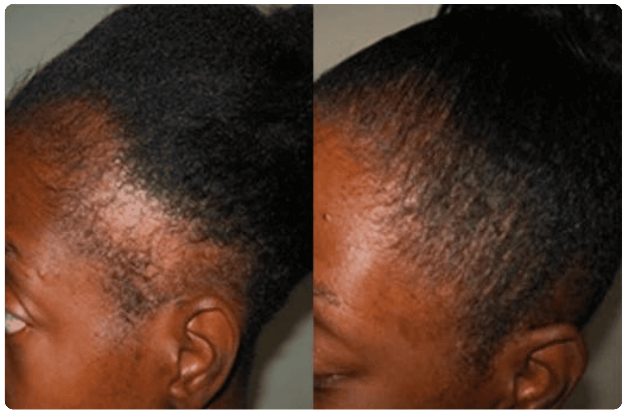 Batana Oil Review: My Hair Growth Journey